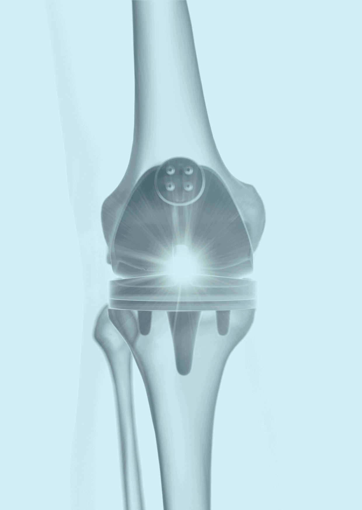 mobilità-sanitaria-europea-SEF_protesi-ginocchio