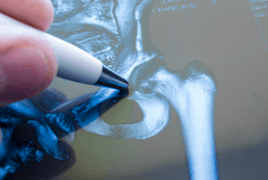 coxartrosi artrosi degenerativa anca