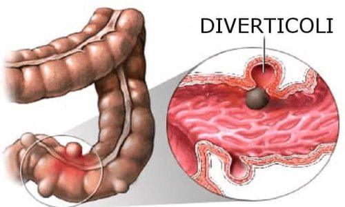 Diverticoli Colon