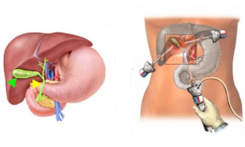 colicistectomia laparoscopica