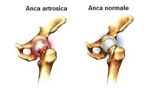 coxartrosi o artrosi dellanca