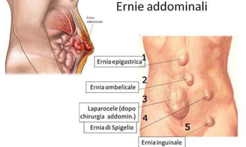 ernie-della-parete-addominale