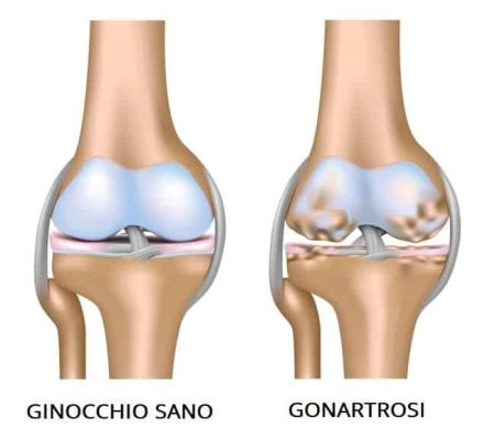 gonartrosi-artrosi del ginocchio