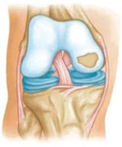 lesione osteocondriale