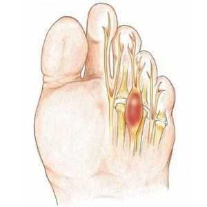 Neuroma di morton